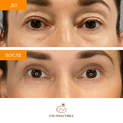 Верхняя и нижняя блефаропластика изображение №1 Верхняя и нижняя блефаропластика