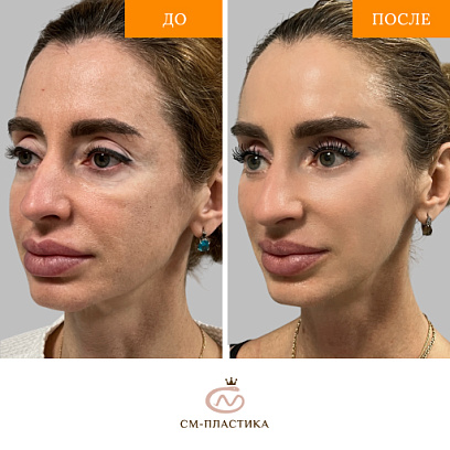 Эндоскопический лобновисочный лифтинг, верхняя и нижняя блефаропластика, лифтинг средней трети лица изображение №1 Эндоскопический лобновисочный лифтинг, верхняя и нижняя блефаропластика, лифтинг средней трети лица