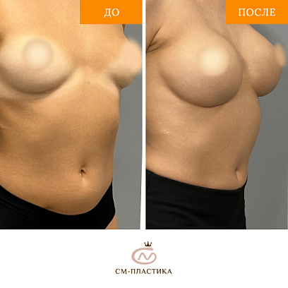 Увеличение молочных желез силиконовыми имплантами изображение №1 Увеличение молочных желез силиконовыми имплантами